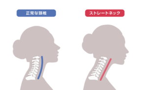 姿勢の悪さが原因？ストレートネックによる肩こり・頭痛を改善する方法 | きりん鍼灸整骨院